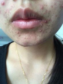 小度痘痘了吃瓜,一场吃瓜引发的美丽蜕变